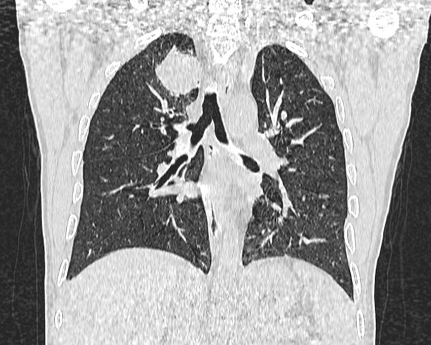 Bronchogenic carcinoma with superior vena cava syndrome (Radiopaedia 36497-38054 Coronal lung window 53).jpg