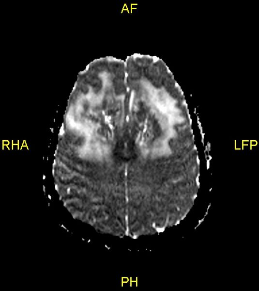 File:Butterfly glioma (Radiopaedia 76707-88526 Axial ADC 19).jpg