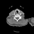 C2 fracture with vertebral artery dissection (Radiopaedia 37378-39200 A 108).png