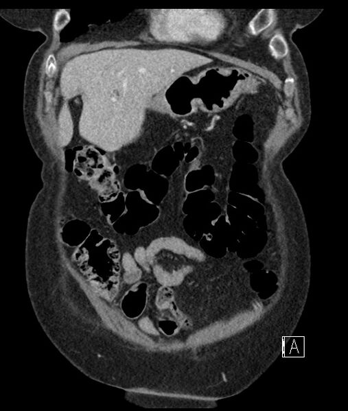 File:Calcified adrenal glands and Spigelian hernia (Radiopaedia 49741-54988 B 23).jpg