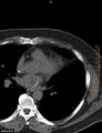 Calcified cardiac fibroma (Radiopaedia 39267-41519 Axial non-contrast 6).jpg
