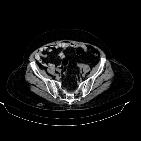 File:Calcified hydatid cyst (Radiopaedia 62000-70085 Axial non-contrast 86).jpg