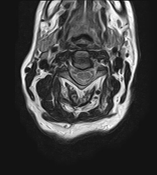 File:Calcified meningioma - cervical canal (Radiopaedia 70136-82468 Axial T2 14).jpg