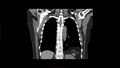 Calcified spleen (Radiopaedia 60952-68768 Coronal non-contrast 6).jpg