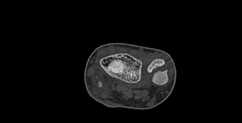 File:Calcifying aponeurotic fibroma (Radiopaedia 88423-105064 Axial bone window 35).jpg