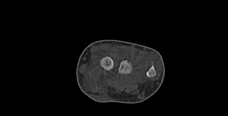 File:Calcifying aponeurotic fibroma (Radiopaedia 88423-105064 Axial bone window 45).jpg