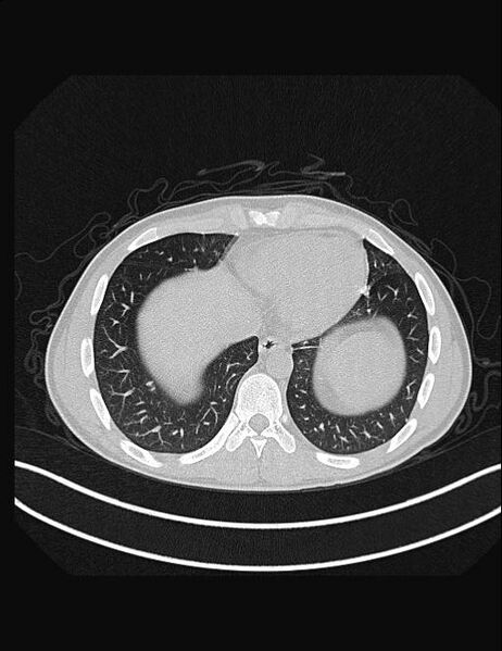 File:Calcifying pulmonary metastases (Radiopaedia 33359-34396 Axial lung window 49).jpg