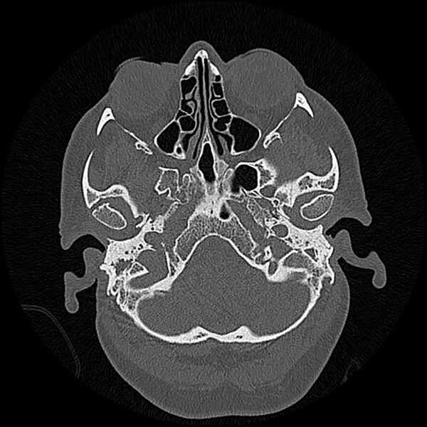 File:Canal up mastoidectomy (Radiopaedia 78108-90638 Axial bone window 35).jpg