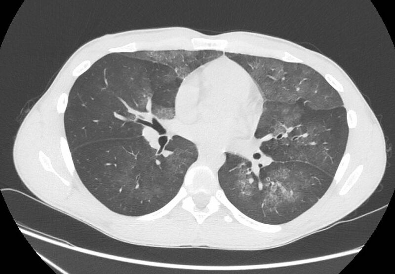 File:Cannabis-induced diffuse alveolar hemorrhage (Radiopaedia 89834-106946 Axial lung window 60).jpg