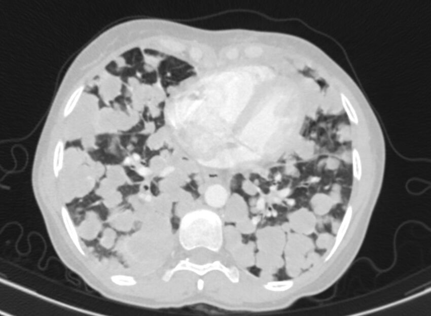 Cannonball metastases from breast cancer (Radiopaedia 91024-108569 Axial lung window 68).jpg