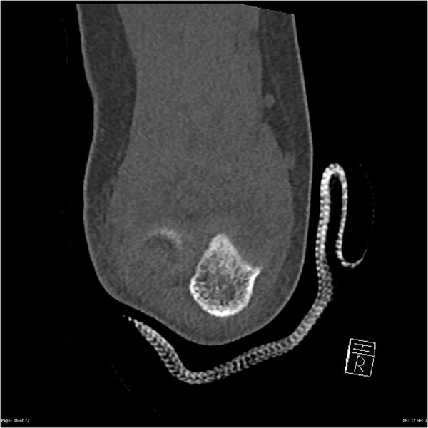 File:Capitellum fracture (Radiopaedia 23352-23426 Coronal bone window 36).jpg