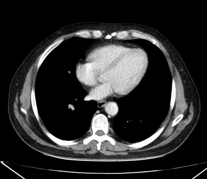 File:Carcinoid tumor with hepatic metastases (Radiopaedia 22651-22670 C 23).jpg