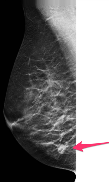 File:Carcinoma right breast (Radiopaedia 37991-39940 Tomosynthesis 1).png