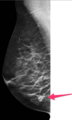 Carcinoma right breast (Radiopaedia 37991-39940 Tomosynthesis 1).png