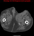 Cardiac perforation following transcatheter aortic valve implantation (Radiopaedia 23714-23863 B 23).png