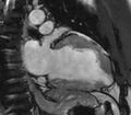 Cardiac sarcoidosis (Radiopaedia 39811-42243 B 16).jpg