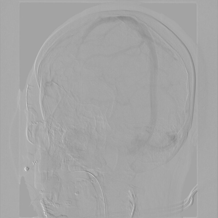 Caroticocavernous fistula - direct (Radiopaedia 61660-69666 Oblique Left ICA 62).jpg