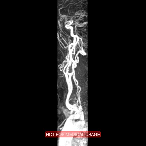 File:Carotid artery stenosis (Radiopaedia 28786-29087 3D MRA 15).jpg
