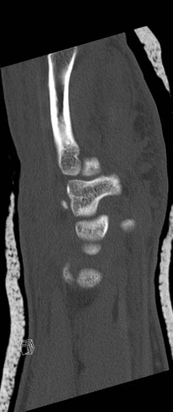 File:Carpal fractures (smart watch impaction) (Radiopaedia 55844-62430 Sagittal bone window 13).jpg