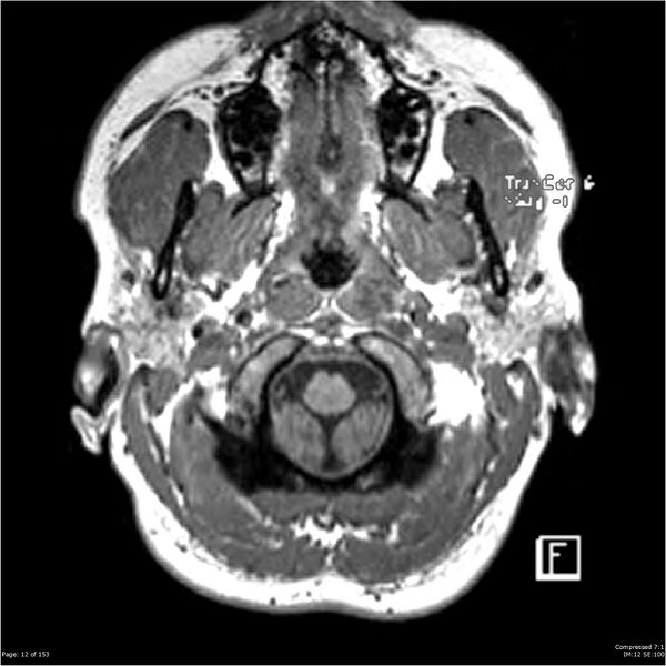 File:Cavernous malformation (cavernous angioma or cavernoma) (Radiopaedia 36675-38237 Axial T1 1).jpg
