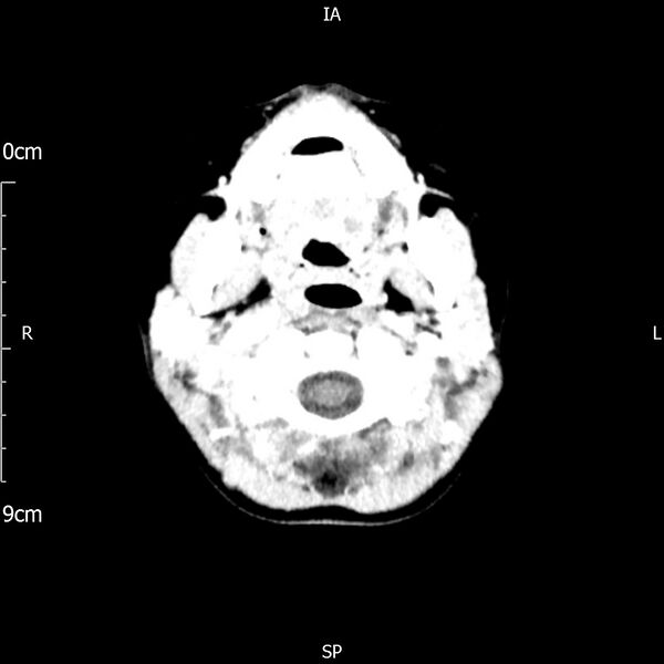 File:Cavernous sinus thrombosis (Radiopaedia 79414-92510 Axial Brain 37).jpg