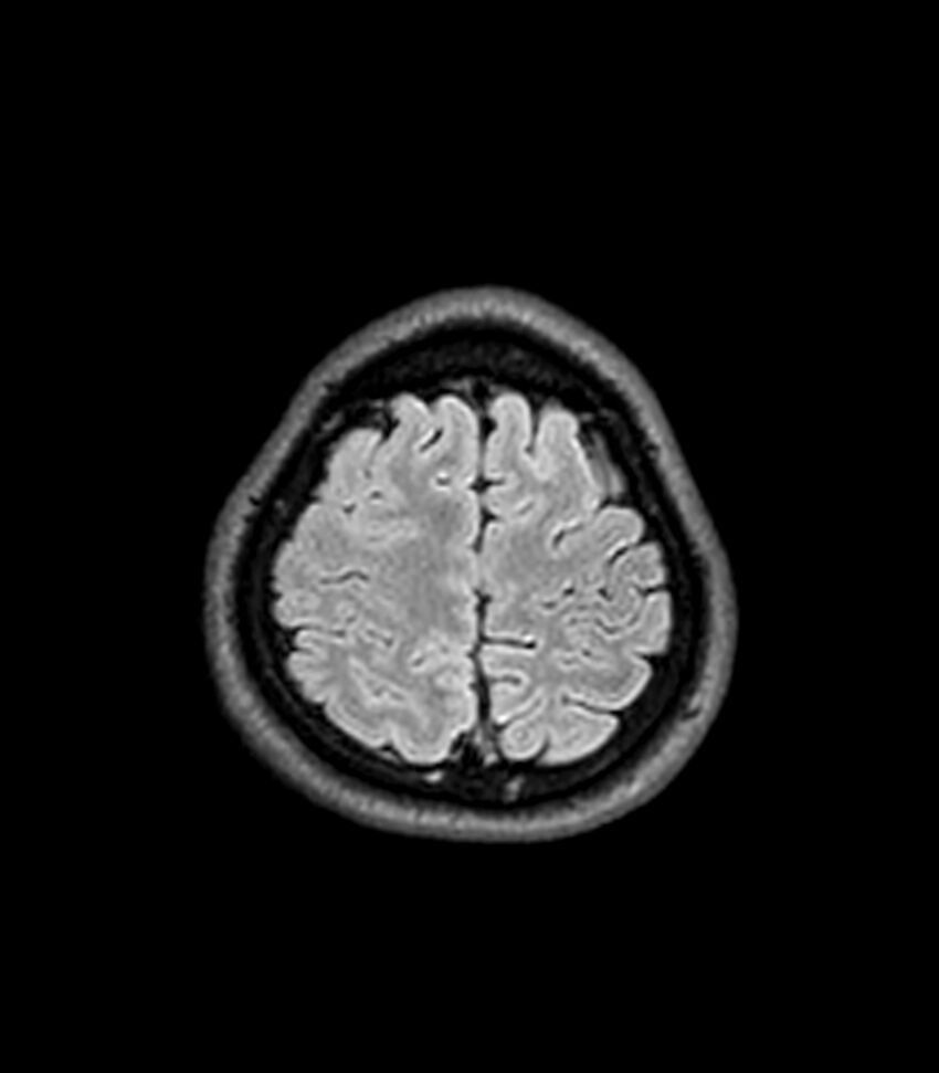 Central neurocytoma (Radiopaedia 79320-92380 Axial FLAIR 62).jpg