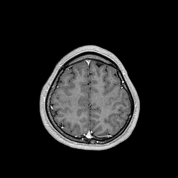 File:Central neurocytoma (Radiopaedia 79320-92380 Axial T1 C+ 192).jpg