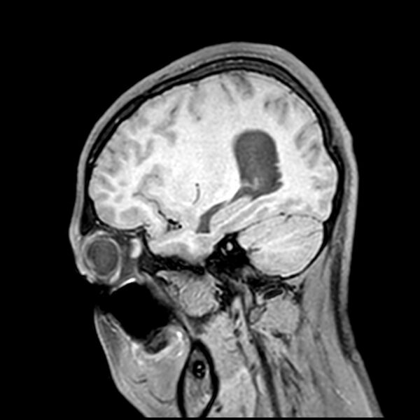 File:Central neurocytoma (Radiopaedia 79320-92380 Sagittal T1 186).jpg