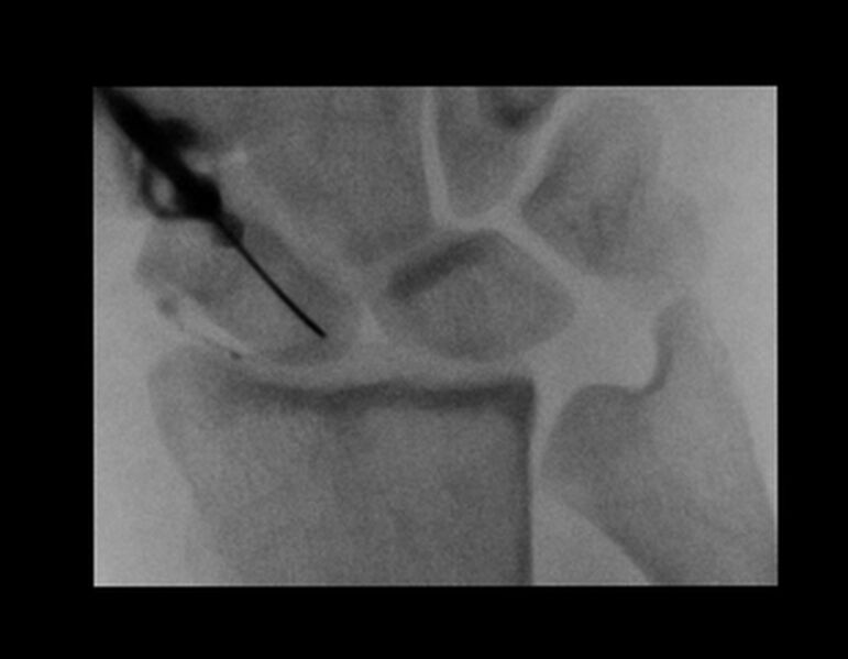 File:Central triangular fibrocartilage perforation (Radiopaedia 73346-86989 Dorsoventral 2).jpg