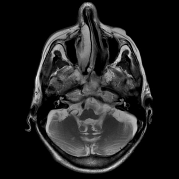 File:Cerebellar ataxia with neuropathy and vestibular areflexia syndrome (CANVAS) (Radiopaedia 74283-85159 Axial T2 6).jpg