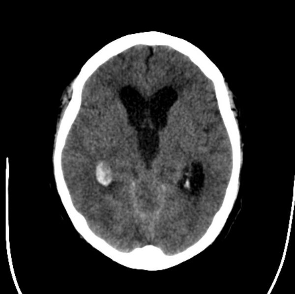File:Cerebellar hemorrhage causing obstructive hydrocephalus (Radiopaedia 33989-35207 Axial non-contrast 23).jpg