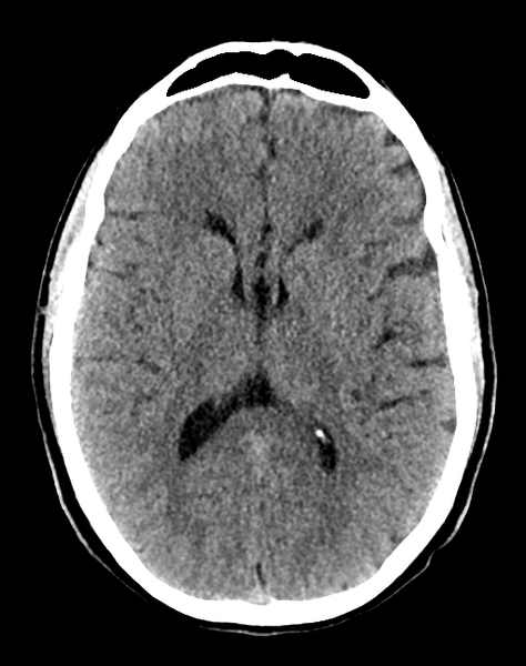 File:Cerebellar infarct due to vertebral artery dissection with posterior fossa decompression (Radiopaedia 82779-97033 Axial non-contrast 20).png