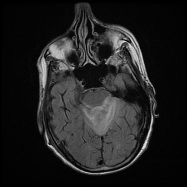 File:Cerebellar metastasis - lung tumor (Radiopaedia 69317-79147 Axial FLAIR 14).jpg