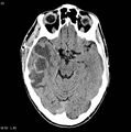 Cerebral abscess (Radiopaedia 6022-7523 Axial non-contrast 1).jpg