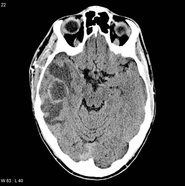 File:Cerebral abscess (Radiopaedia 6022-7523 Axial non-contrast 1).jpg