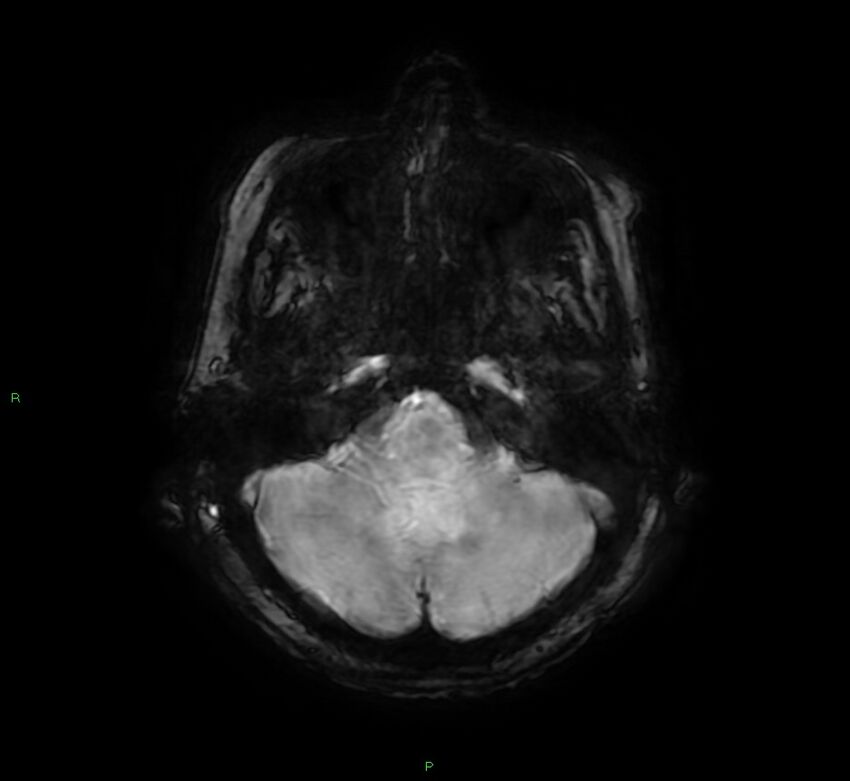 Cerebral amyloid angiopathy-associated lobar intracerebral hemorrhage (Radiopaedia 58378-65517 Axial SWI 15).jpg