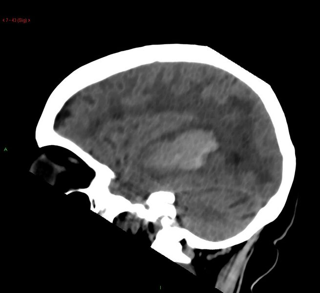 File:Cerebral amyloid angiopathy-associated lobar intracerebral hemorrhage (Radiopaedia 58378-65518 C 43).jpg