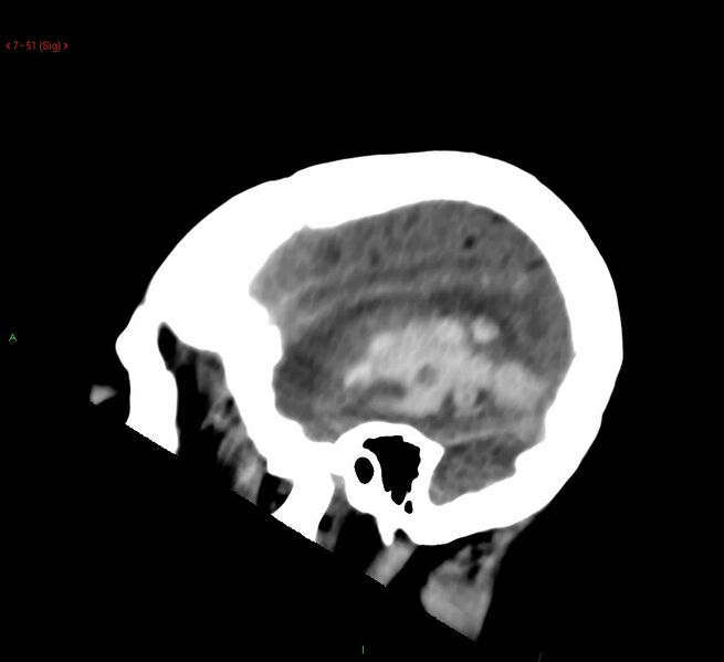 File:Cerebral amyloid angiopathy-associated lobar intracerebral hemorrhage (Radiopaedia 58378-65518 C 51).jpg