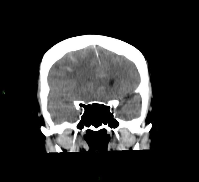File:Cerebral amyloid angiopathy-associated lobar intracerebral hemorrhage (Radiopaedia 58756-65977 Coronal non-contrast 44).jpg