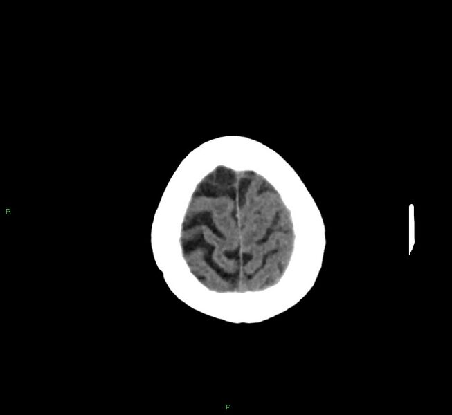 File:Cerebral amyloid angiopathy-associated lobar intracerebral hemorrhage (Radiopaedia 58757-65978 Axial non-contrast 8).jpg