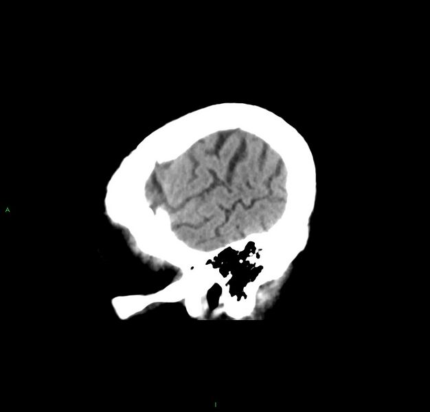 File:Cerebral amyloid angiopathy-associated lobar intracerebral hemorrhage (Radiopaedia 59356-66716 C 47).jpg