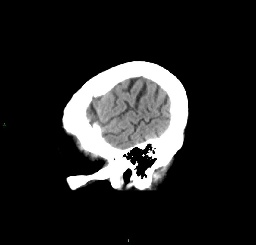 Cerebral amyloid angiopathy-associated lobar intracerebral hemorrhage (Radiopaedia 59356-66716 C 47).jpg