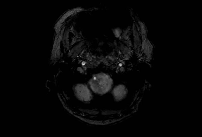 File:Cerebral amyloid angiopathy (Radiopaedia 86671-102792 Axial Gradient Echo 54).jpg