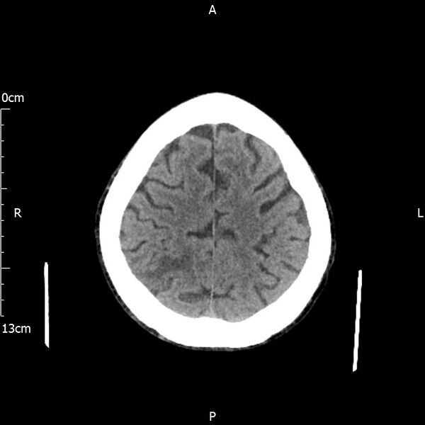 File:Cerebral amyloid angiopathy related inflammation (Radiopaedia 72772-83480 Axial non-contrast 22).jpg
