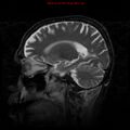Cerebral and orbital tuberculomas (Radiopaedia 13308-13311 Sagittal T2 13).jpg