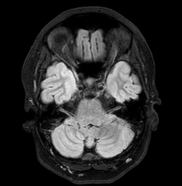 File:Cerebral arteriovenous malformation (Radiopaedia 74411-90758 Axial FLAIR 8).jpg