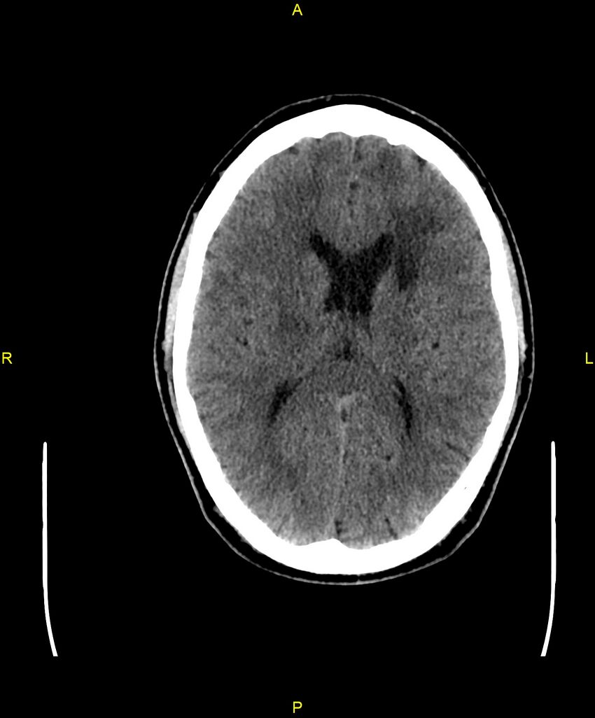 Cerebral autosomal dominant arteriopathy with subcortical infarcts and leukoencephalopathy (CADASIL) (Radiopaedia 86108-102051 Axial non-contrast 62).jpg