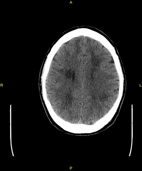 File:Cerebral autosomal dominant arteriopathy with subcortical infarcts and leukoencephalopathy (CADASIL) (Radiopaedia 86108-102051 Axial non-contrast 74).jpg