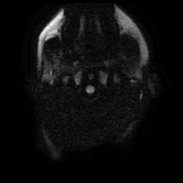 File:Cerebral cavernous malformation (Radiopaedia 44301-47942 Axial DWI 1).jpg