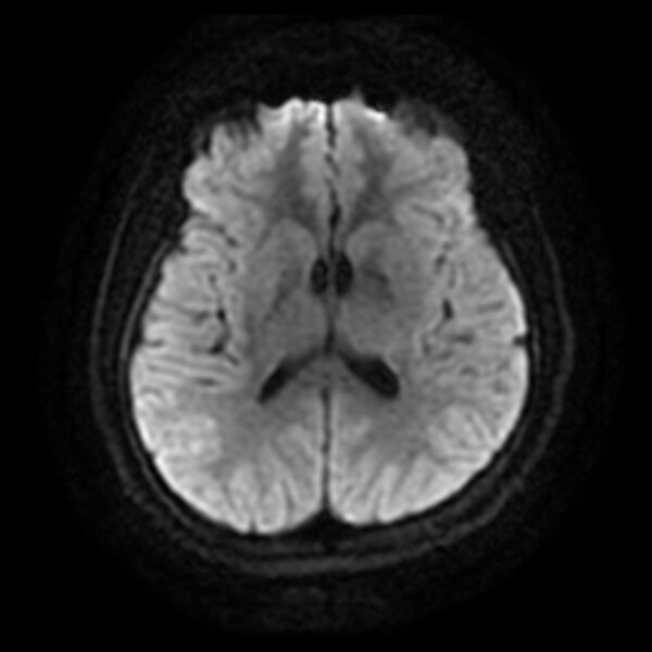 File:Cerebral cavernous malformation (Radiopaedia 44301-47942 Axial DWI 12).jpg